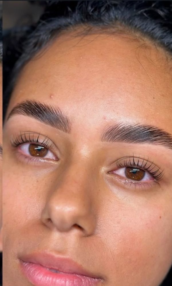 Brow Lift
